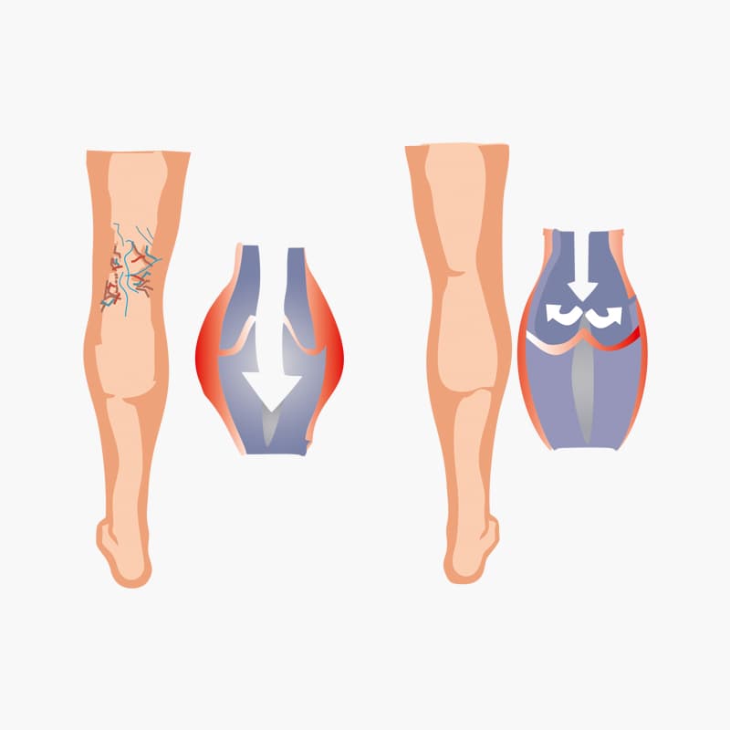 Periferik Örgülü Mikrokateter Set